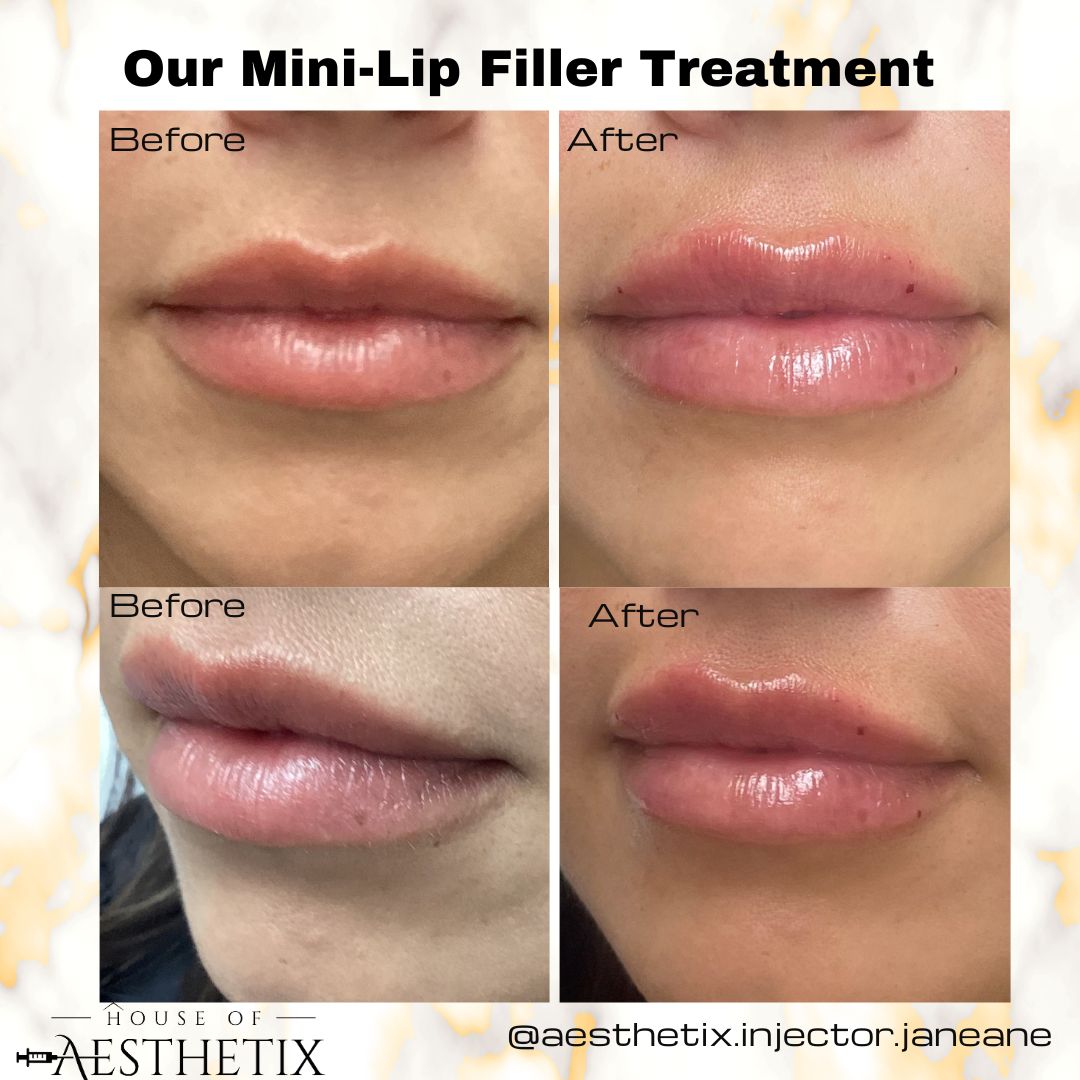 Unlocking the Secrets to Natural-Looking Lips with Fillers